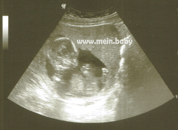 Mein-Baby-Ultraschallbild-16-ssw
