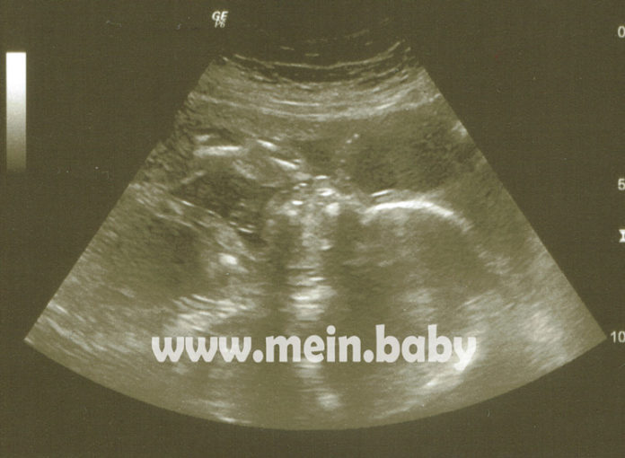 Mein Baby Ultraschallbild aus der 24. SSW